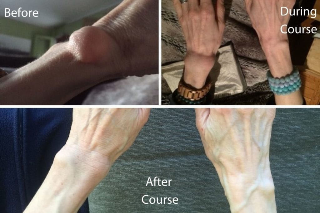 cyst before and after