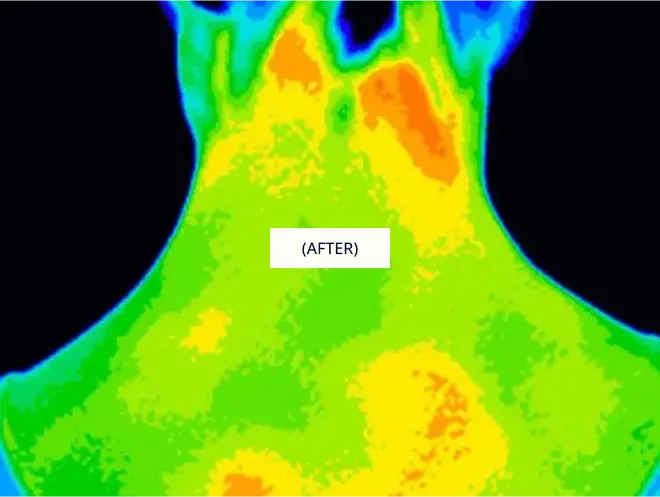 Thermography After