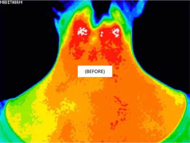 Thermography Before